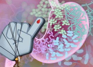 Researchers found that the makeup of the gut microbiome can be a determiner for the efficacy of exercise with prediabetics