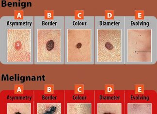 Researchers discovered that there are many human melanoma cell lines that have completely lost expression of STING