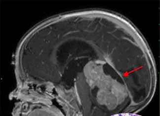 Medication prescribed for a certain type of epilepsy may offer a new method for treating malignant infantile brain tumors
