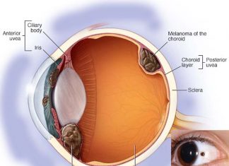 A simple blood test could soon detect melanoma in the eye