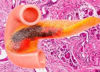 Scientists identified a combination of two anti-cancer compounds that shrank pancreatic tumors