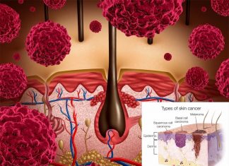 Some of the most deadly skin cancers may start in stem cells that lend color to hair
