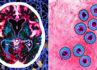 Alzheimer’s disease it’s not linked with herpes virus