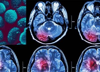 Cryptococcal meningitis is a leading cause of death among adults with HIV/AIDS in sub-Saharan Africa