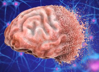 Important risk factors for dementia have been increasing rapidly