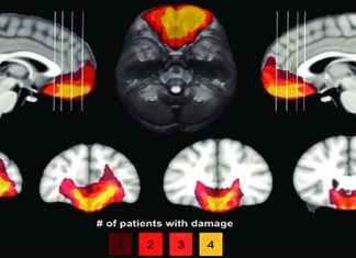 Orbitofrontal cortex Damage to this brain region impairs decision-making