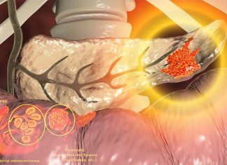 Israeli researchers founds a small molecule known as PJ34 that induce the self-destruction of pancreatic cancer as much as 90 percent a month