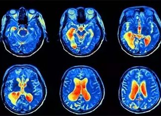 MRI illuminates abnormalities in the brains of people with depression