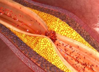 Patients with elevated levels of triglycerides in their blood has a significantly higher mortality rate