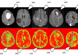 Artificial intelligence is 95 percent accurate at diagnosing real-time intraoperative brain tumors