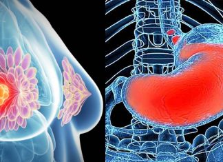 Acid reflux drugs may have an unintended side effect: impairment of breast cancer survivors