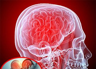 Cerebral edema is a severe complication of stroke linked to glymphatic system malfunction