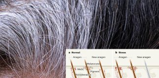 Gray hair : stress is the source