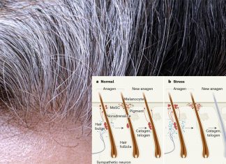 Gray hair : stress is the source
