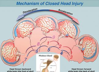 Post-TBI syndrome impairs hormone production – disrupting sleep cognition – memory