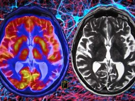 Progressive supranuclear palsy (PSP) and corticobasal syndrome (CBS) may be twice as common as previously believed