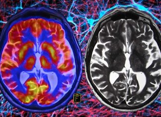 Progressive supranuclear palsy (PSP) and corticobasal syndrome (CBS) may be twice as common as previously believed