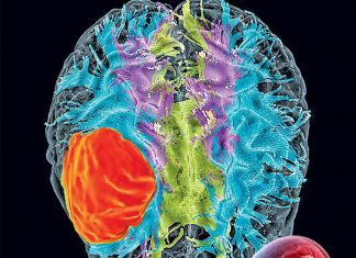 The VEGF-C treatment significantly extended the life span of the mice with glioblastoma brain cancer