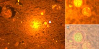 Researchers found a close association between high aluminum content in brain tissue and Alzheimer’s disease