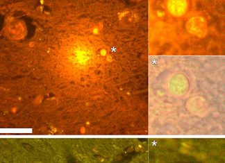 Researchers found a close association between high aluminum content in brain tissue and Alzheimer’s disease