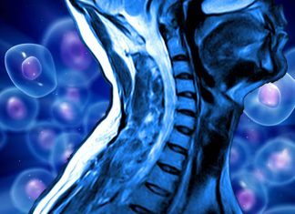 Researchers have developed a new method for delivering neural precursor cells into spinal cord injury