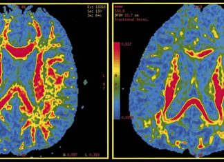 Protein encoded by gene FAM222A is linked to the development of Alzheimer’s disease