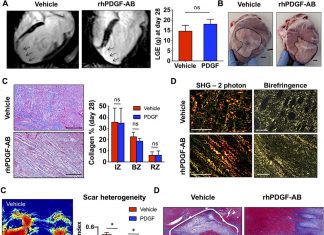 A protein therapy – recombinant human platelet-derived growth factor-AB (rhPDGF-AB) could improve outcomes following heart attack