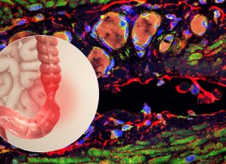 An infection may contribute to irritable bowel syndrome (IBS) by damaging the gut nervous system