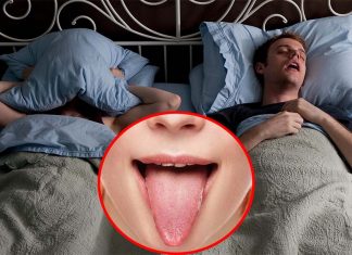 Reduction in tongue fat volume is the main link between weight loss and sleep apnea improvement