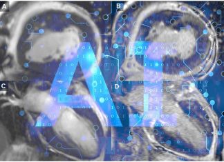 AI can analyze CMR scans and detect increase risk of stroke – heart attacks – heart failure