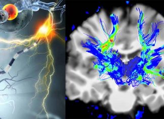 Parkinson’s disease : new MRI technique detect iron deposits in brain and track declines in thinking