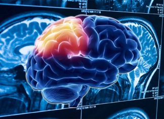 Severe TBI is associated with a greater risk of mental health conditions