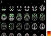 Six proteins can be used to assess a risk of developing cerebral small vessel disease (CSVD)