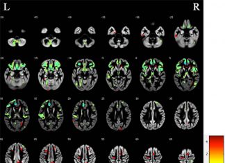 Six proteins can be used to assess a risk of developing cerebral small vessel disease (CSVD)