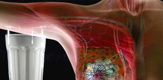 Intake of dairy milk is associated with a greater risk of breast cancer in women