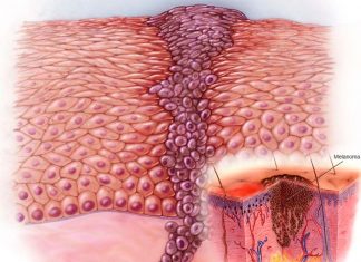 Researchers has developed a medicated patch for treating melanoma