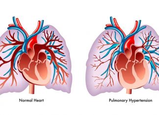 Specific gut bacteria may contribute to and predict the development of pulmonary arterial hypertension (PAH)