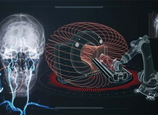 Doctors have successfully used robotic technology to treat brain aneurysms