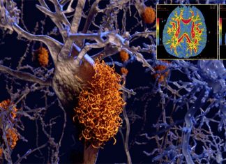 Dantrolene shows promise in the treatment of Alzheimer’s disease