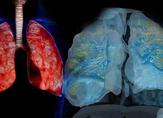 Tissue plasminogen activators (tPA) may help COVID-19 patients in danger of respiratory failure