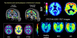 Why do some people get Alzheimer’s disease while others do not ?