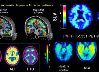 Why do some people get Alzheimer’s disease while others do not ?