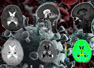 WARNING : A patient who tested positive for COVID-19 developed acute necrotizing encephalitis (ANE)