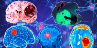 Glioma brain tumors disrupt neural synchrony between bilateral cortical regions