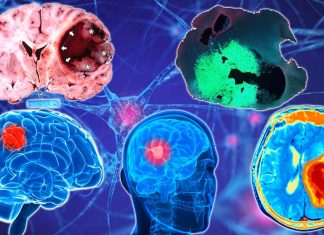 Glioma brain tumors disrupt neural synchrony between bilateral cortical regions