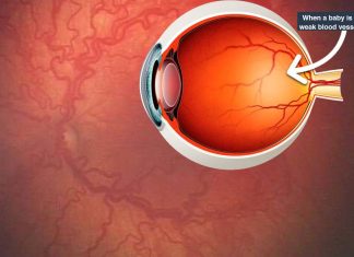 Preterm infants – the drug Avastin is effective for preventing blindness