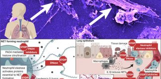 COVID-19 : New research finds a connection between neutrophil extracellular traps (NETs) and a more severe disease course