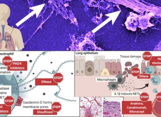 COVID-19 : New research finds a connection between neutrophil extracellular traps (NETs) and a more severe disease course