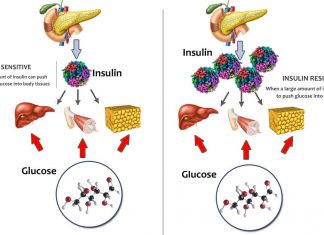Body weight and fat distribution are linked to brain insulin sensitivity