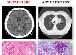 Researchers have uncovered a genetic variant that drives aggressive head – neck and lung cancers in Asian population
